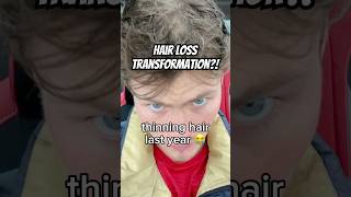 MY HAIR LOSS TRANSFORMATION 😁 shorts hair [upl. by Olnee716]