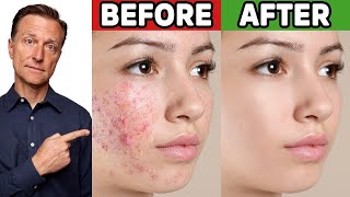 The Best Trick for Clear Skin Acne Aging Wrinkles Liver Spots [upl. by Attezi779]