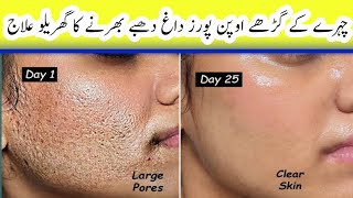 ONE SOLUTION  REMOVE ACNE SCARS PIMPLES AT HOME  GUARANTEED CLOSE Large Open Pores [upl. by Dnalro]