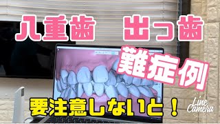 八重歯 出っ歯の難症例を白いワイヤー矯正 マウスピース矯正の不適応症例 大宮 鈴木歯科医院 矯正歯科 [upl. by Atekan]