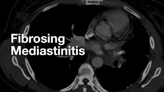 Classic Case Fibrosing Mediastinitis [upl. by Flanagan]