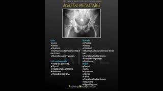 Skeletal metastases [upl. by Yeldahc]