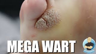 MONSTER MOSAIC WART REMOVAL [upl. by Packer]