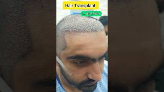 Best Hair Transplant Result in India  How to stop Hairfall hairclinic hairtransplant youtube [upl. by Bengt]