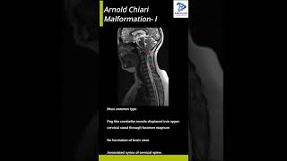 Arnold Chiari Malformation I [upl. by Bloomer329]