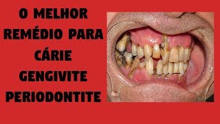 O Melhor Tratamento e Remédio Caseiro DO MUNDO Para Cárie Gengivite e Periodontite [upl. by Asoj]