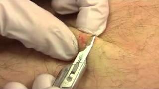 Shave Biopsy [upl. by Bock135]