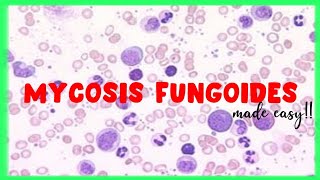 Mycosis Fungoides  WBC disorders  Sezary Syndrome [upl. by Jamila]