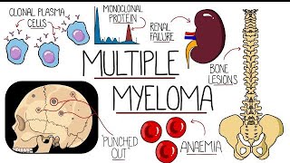 Multiple Myeloma sign and symptoms Treatment Management NCLEXRN REVISION [upl. by Hayman]