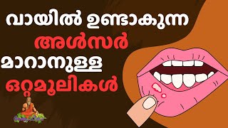 വായിൽ ഉണ്ടാകുന്ന അൾസർ മാറാനുള്ള ഒറ്റമൂലികൾ ottamooli angaadikada homeremedies [upl. by Dnalkrik]