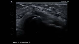 Nerve ultrasound case  fibular peroneal nerve entrapment and a fabella [upl. by Dewayne]