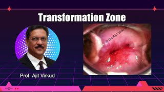 Tranformation Zone Masterclass [upl. by Hansel]