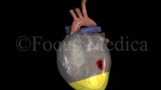 Pericardial effusion  Heart [upl. by Nylirad]