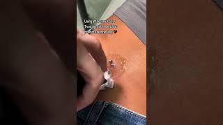 Piercing Migration Treatment  Piercing Bump Removal ft Base Laboratories Piercing Bump Treatment [upl. by Bast117]