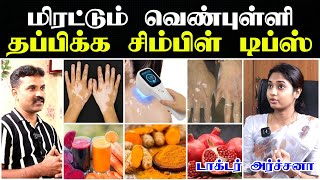 வெண்புள்ளி மறைய  Venpulli starting stage  vitiligo skin disease treatment tamil Doctor Interview [upl. by Nnylamme]