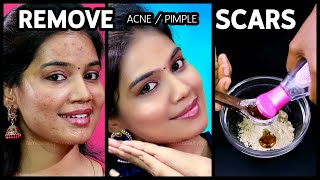 Acne Scars Home Remedies in Tamil  Pimple Marks Removal at Home [upl. by Meggs54]