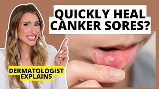 Quickly Heal Canker Sores How to Prevent amp Heal Them Faster  Dermatologist Explains [upl. by Tyika]