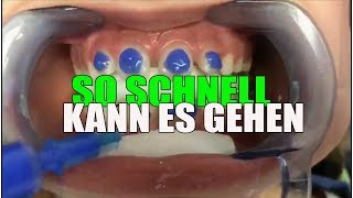 SO SCHNELL wird die FESTE ZAHNSPANGE eingesetzt  Orthodentix [upl. by Lean182]