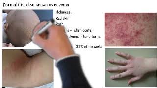 Dermatitis vs Eczema are they same Types of dermatitis symptoms prognosis and treatment [upl. by Annabelle755]