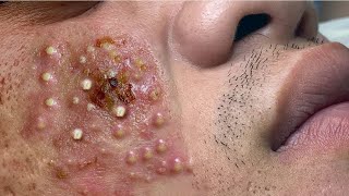 Big Cystic Acne Blackheads Extraction Blackheads amp Milia Whiteheads Removal Pimple Popping  3734 [upl. by Ehtyde249]