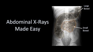 Abdominal XRays Made Easy [upl. by Ecam]