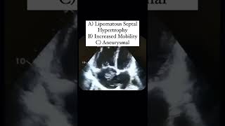 Interatrial Septum Quiz echocardiography [upl. by Immot]