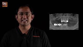 All on 4 Dental Implants  Zygoma Dental Implants for no bone  FMS Dental [upl. by Folsom]