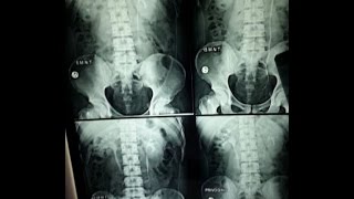 IVPIVU Intravenous UrographyPyelography BASICS OF RADIOGRAPH EXPLAINED [upl. by Hajin]