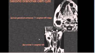 IMAGING CYSTIC NECK MASSES Dr Ahmed Esawy [upl. by Ahsiuqel613]