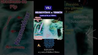 Lesión Pulmonar Inducida por Ventilación Mecánica VILI Lung injury [upl. by Dnalor537]