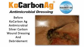 KoCarbon Ag Antimicrobial Silver Carbon Wound Dressing Case Study 3  Healed A Sacral Pressure Ulcer [upl. by Lletnahs]