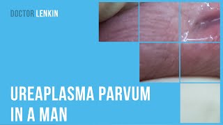 😟 Ureaplasma parvum in a man [upl. by Oliric607]