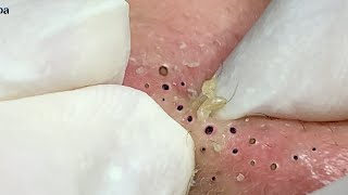 Its So Amazing Blackheads  Part 2  GaSpa 01032022 [upl. by Rahas385]