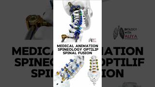 Medical Animation Spineology OptiLIF Spinal Fusion medical animation 3d short [upl. by Eisteb]