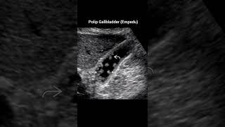 Polyp gallbladderpolip empedu usg radiology polyps gallbladder batu xray [upl. by Eibba]