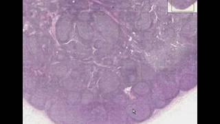 Histopathology Lymph node  Follicular hyperplasia [upl. by Madi586]