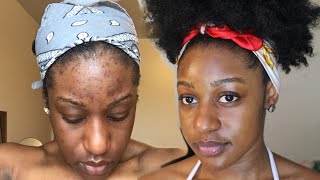 HOW TO CLEAR ACNE IN LESS THAN A MONTH [upl. by Zeta]