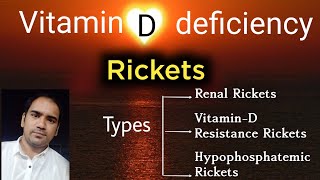 VitaminD deficiency  Rickets and types of rickets RenalVitamin D resistance amp Hypophospatemic [upl. by Akyssej]