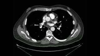 Tromboembolismo Pulmonar Angio tomografia [upl. by Tebazile]