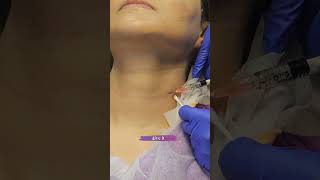 skinbooster  dermalfillers for Neck lines profhilo viscoderm antiagingtreatment skincaretips [upl. by Dollie301]