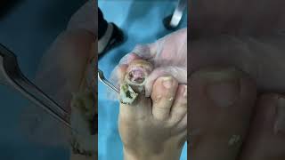 Callus removal and Dead skin removal Teonail Removal from Feet ep41  Yin Clinic [upl. by Leak]