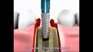 Dental implant procedure [upl. by Keyek]