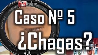 Caso clinico Nº 5¿ Enfermedad de chagas [upl. by Aicarg744]