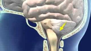 Brainstem Herniation [upl. by Krys]