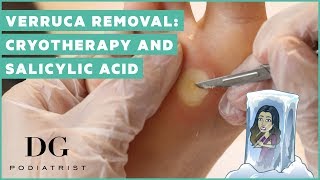 Verruca removal cryotherapy and salicylic acid [upl. by Haleelahk]