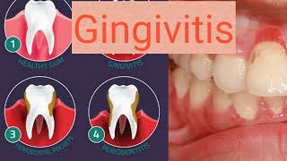 Gingivitis in urduhindi [upl. by Cyler]