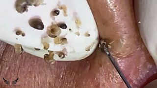 Cystic Acne Blackhead Removal  Elderly Hidden Acne Treatment  Pimple Popping Spa Extraction  060 [upl. by Cadal306]