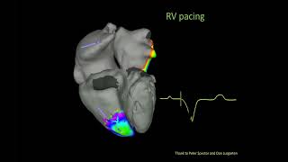 Bradycardia amp Pacing  Cardiology Board Review [upl. by Locin]