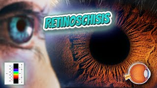 Retinoschisis Your EYEBALLS 👁️👁️💉😳💊🔊💯✅ [upl. by Anilra]