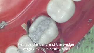 Class II amalgam restoration [upl. by Danelle944]